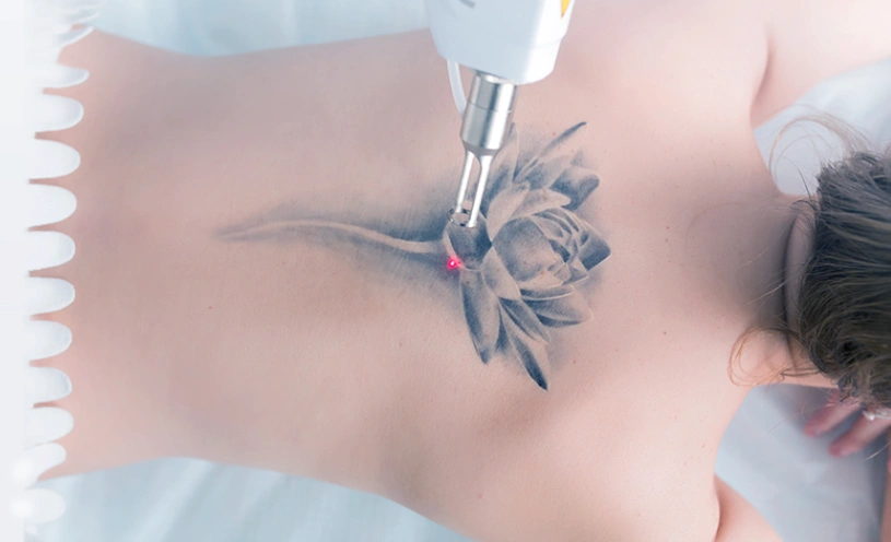 Αφαίρεση Τατουάζ Header Image